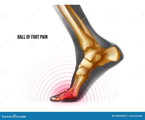 Ball of Foot Pain Bones Skeleton Realistic Anatomy Illustration Stock Vector - Illustration of ...