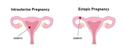 Getting Pregnant after Ectopic Pregnancy | Treatment