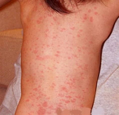 Roseola Rash - Pictures (Photos, Images), Causes, Treatment