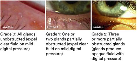 How to manage patients with Meibomian Gland Dysfunction (MGD)