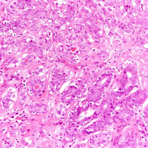 Tubular Adenoma Histology