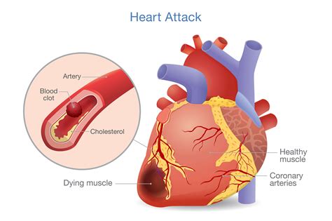 Time to reassess fluids for chronic heart failure patients | Distance CME