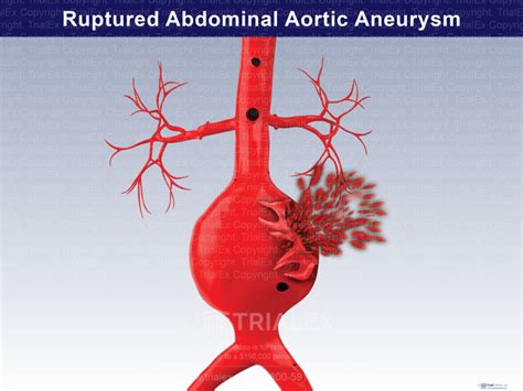 Ruptured Abdominal Aortic Aneurysm - TrialExhibits Inc.