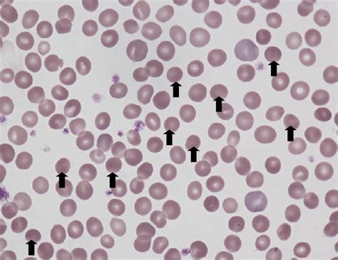 Figure1.Peripheral blood smear (×1,000). Under normal conditions, red... | Download Scientific ...