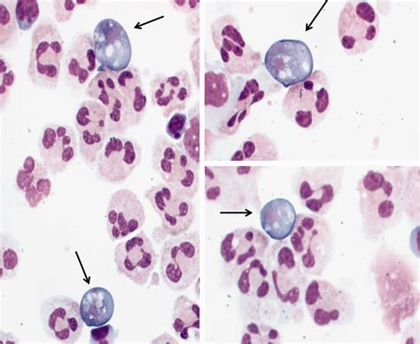 Naegleria fowleri amoeba or brain eating amoeba infection and treatment