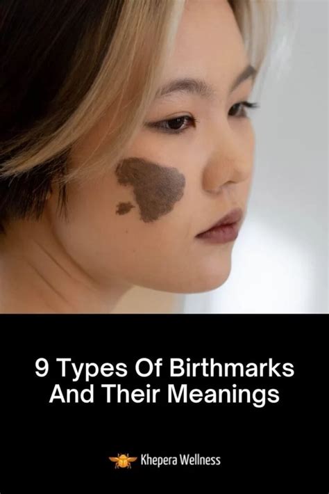 9 Types Of Birthmarks And Their Meanings - Khepera Wellness | Birthmark ...