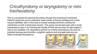 Tracheostomy | PPT