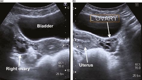 Normal Pelvic Ultrasound