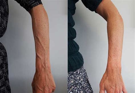 Bulging Arm and Hand Veins: Causes and Treatments - Palm Clinic