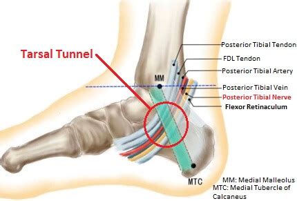 Tarsal Tunnel Syndrome: Causes, Symptoms & Treatment