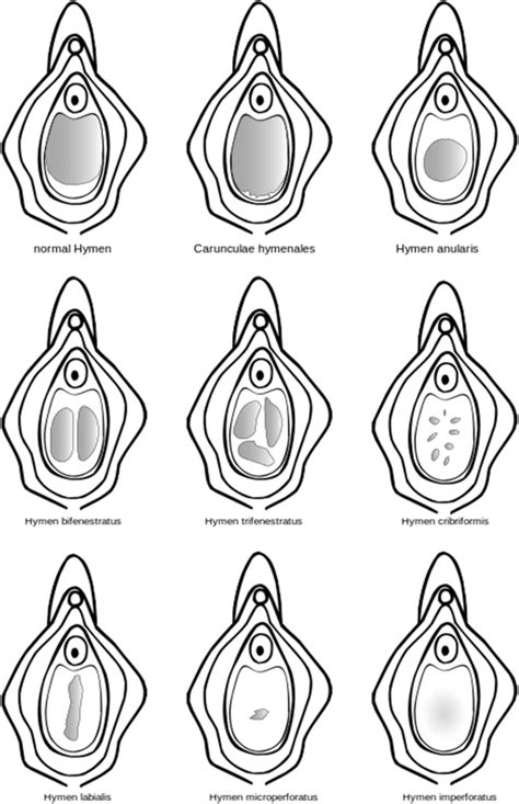 Shows some of the different configurations of the hymen | Download Scientific Diagram