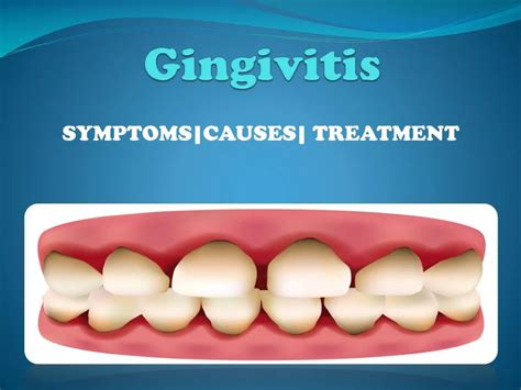 PPT - Gingivitis (Mild Gum Disease) PowerPoint Presentation, free ...