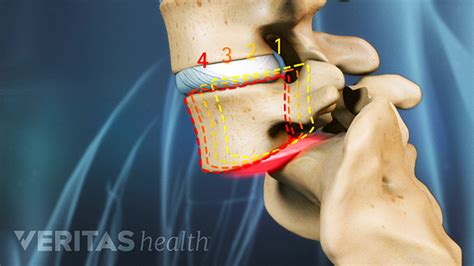 Spondylolysis and Spondylolisthesis