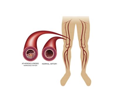 Peripheral Vascular Disease Treatment in Mumbai