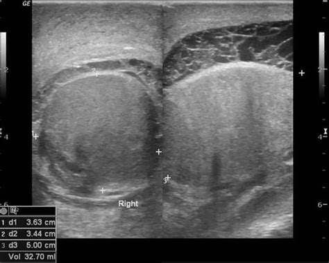 Orchitis - Causes, Symptoms, Diagnosis, Treatment