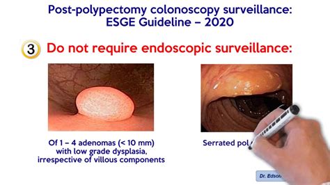 POST-POLYPECTOMY COLONOSCOPY SURVELLAINCE: ESGE GUIDELINES 2020. (Hassan C. et al, Endoscopy ...