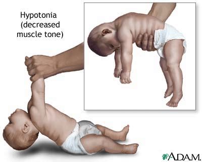 Hypertonia and Hypotonia in Pediatrics - Progressive care