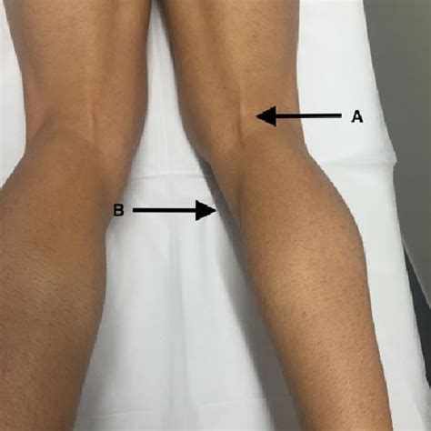 (PDF) Distal Avulsion of the Semitendinosus Tendon: A Case Report