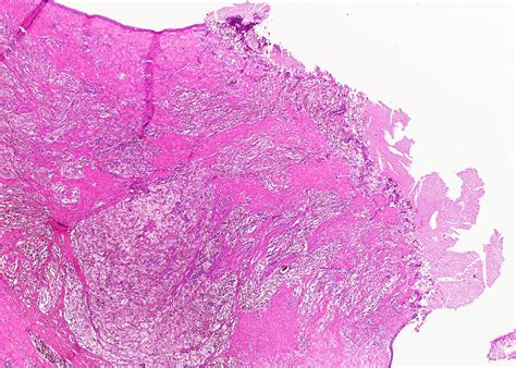 Thyroglossal Duct Cyst Histology