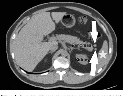 Structure of phrenicosplenic ligament | Semantic Scholar