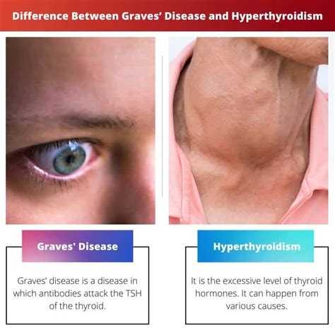 Graves’ Disease vs Hyperthyroidism: Difference and Comparison