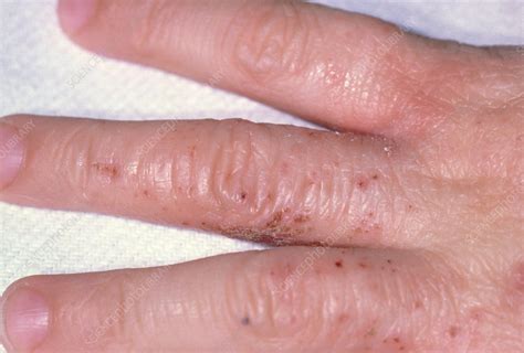 Eczema rash on a child's hand - Stock Image - M150/0063 - Science Photo Library