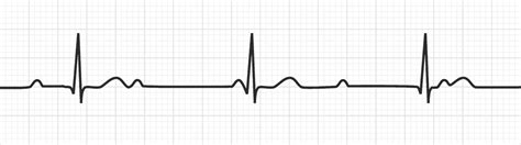 Trifascicular Block | Conduction Disorders - MedSchool