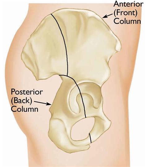 Acetabular fracture causes, symptoms, diagnosis, treatment & prognosis