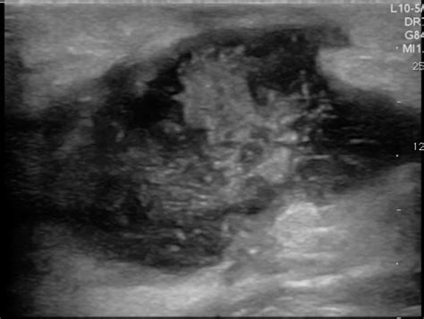 #POCUS for Soft Tissue. Cellulitis, abscess, nec fasc. #foamed #foamus ...