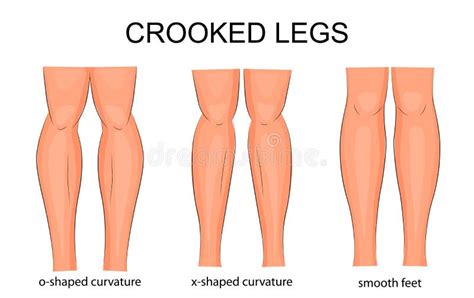 Aventurier liaison diffuser types of legs parfois Inodore Épineux