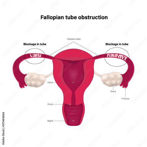 Fallopian tube obstruction. Block fallopian tube. Uterus and uterine ...