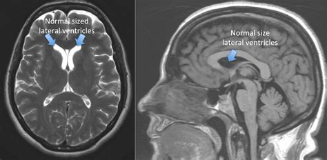 Hydrocephalus - Rocky Mountain Brain and Spine Institute