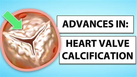 Advances in Heart Valve Calcification Treatment with the Mayo Clinic ...