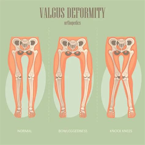 Knee Valgus: How To Fix Knock Knees - Elite Feet