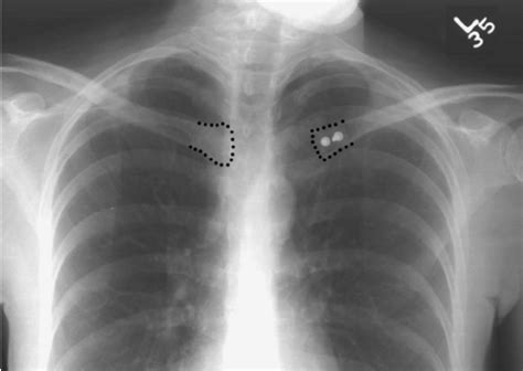 Preoperative (A) anteroposterior and (B) serendipity (Rockwood ...