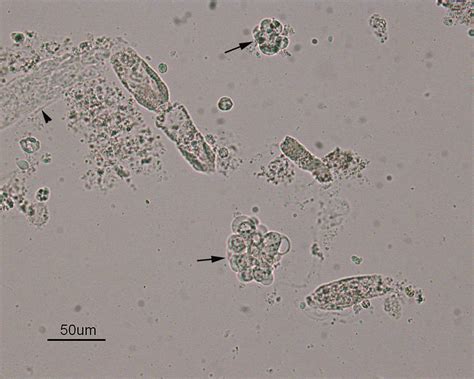 granular cast Archives | eClinpath