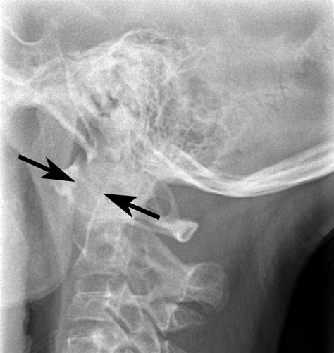 Atlantoaxial Joint Subluxation