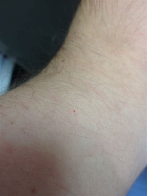 small red dots on skin as if from ballpoint pen. noticed one