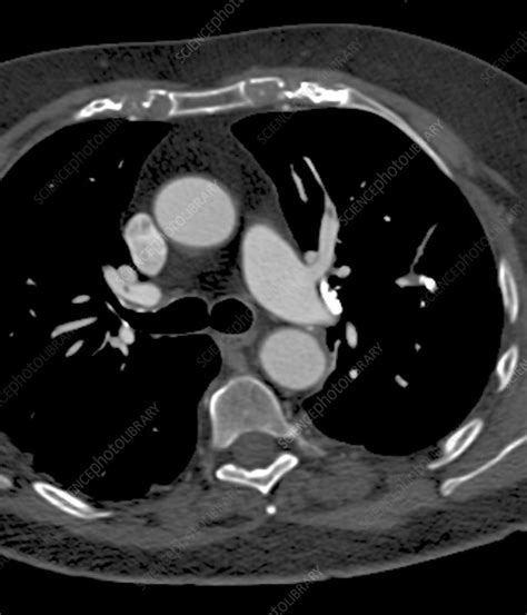 Pulmonary embolism, CT scan - Stock Image - C010/4915 - Science Photo Library