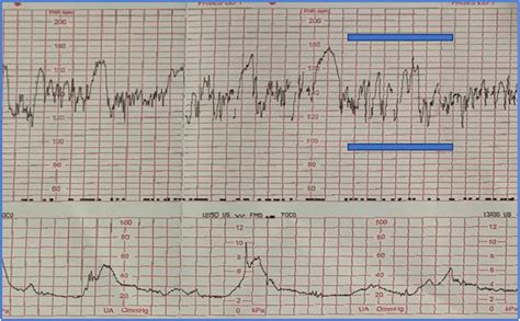 Cardiotocographic features in COVID-19 infected pregnant women