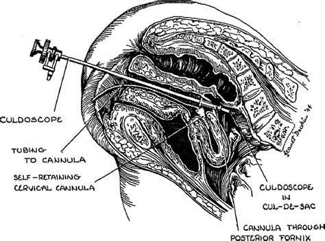 References in Culdoscopy: A Foundation for Natural Orifice Surgery—Past, Present, and Future ...