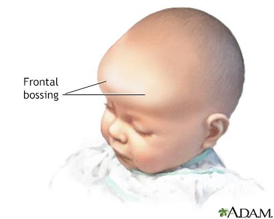 Frontal bossing