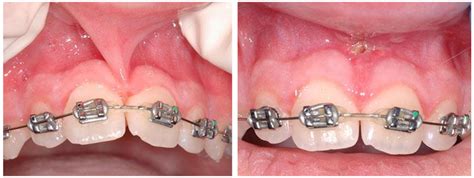 Labial Frenulum Normal