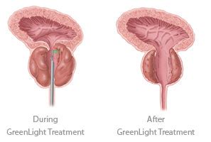 What is a Greenlight Laser Prostatectomy? - QProstate PVP Surgery