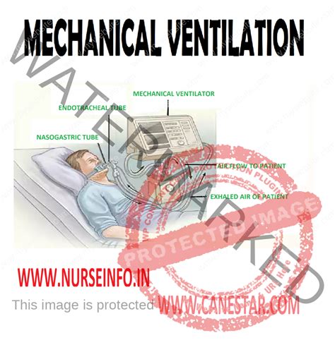 Positive Pressure Mechanical Ventilation