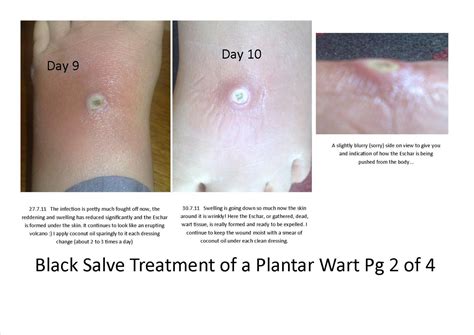 Holistic Therapy Connections: Treatment of a Plantar Wart using Black Salve