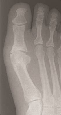 Conservative Care Recommendations For The Stages Of Hallux Limitus/Rigidus