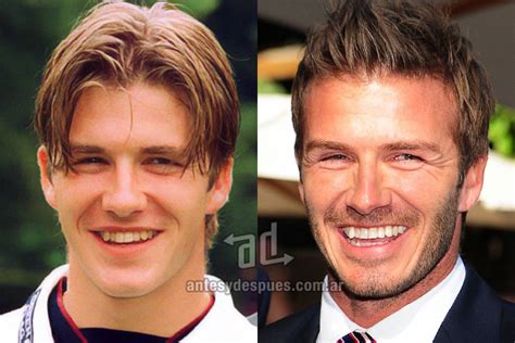 David Beckham Plastic Surgery Before and After Nose Job and Lips Augmentation ~ Celebrity Before ...