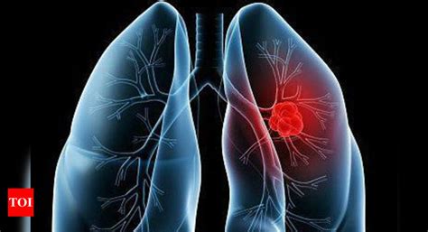 Transudative Pleural Effusion Causes