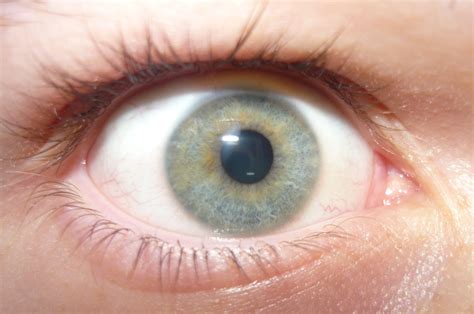 File:Light blue eye with heterochromia.JPG - Wikimedia Commons
